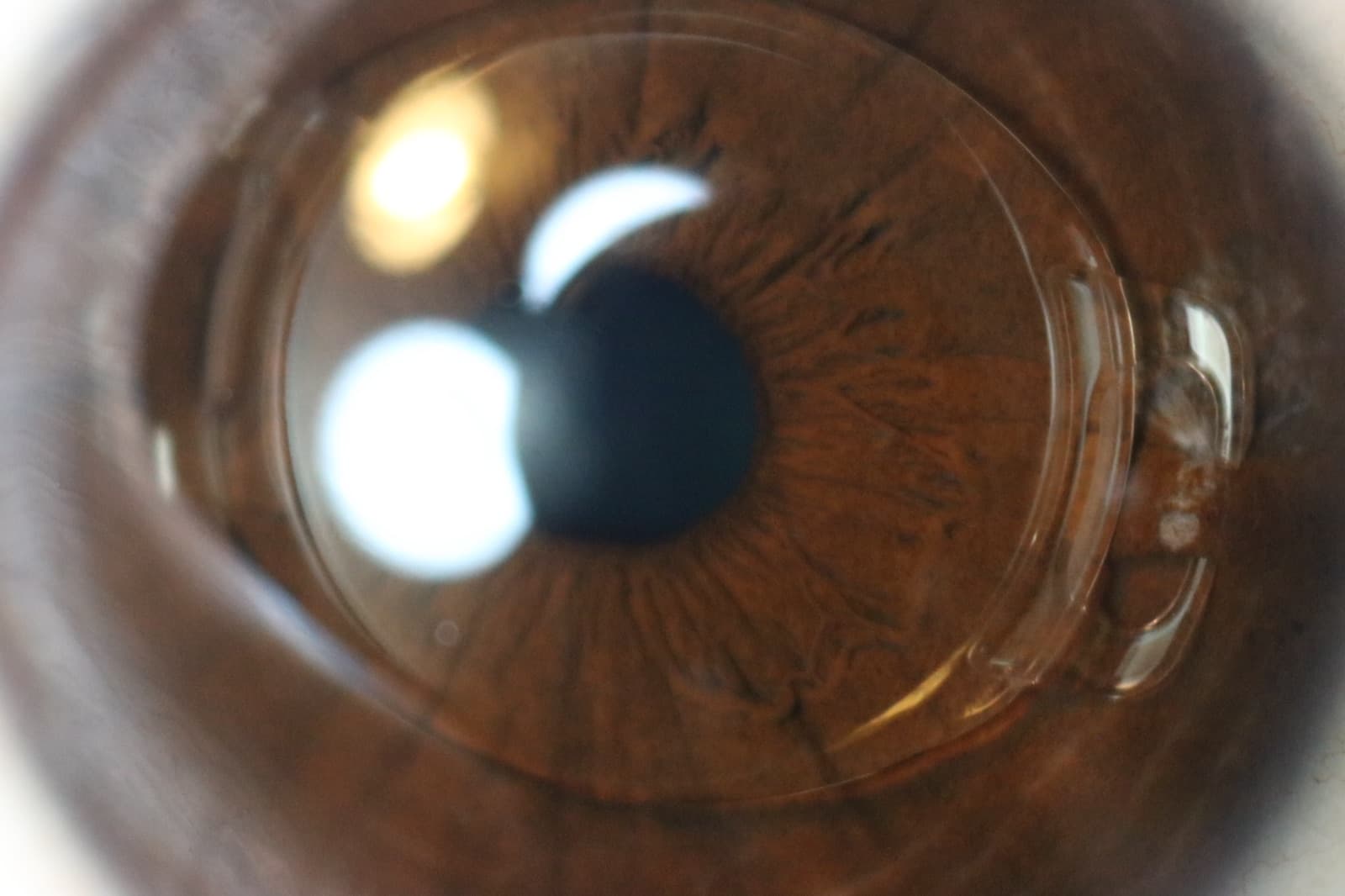 ICL (Implantable Collamer Lens)