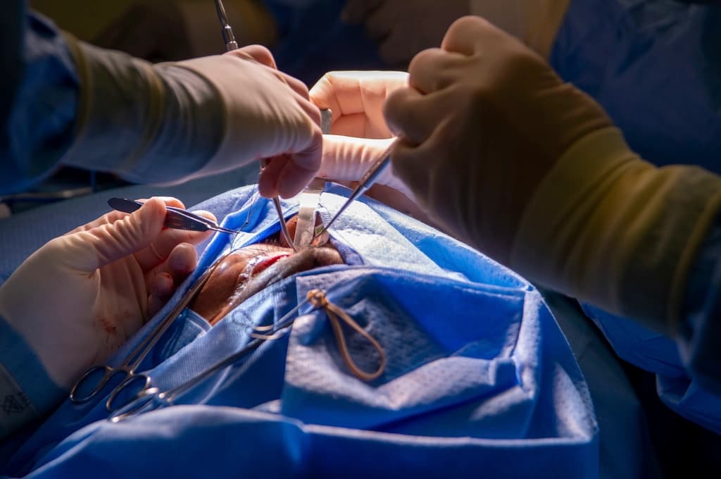 Laser Cataract Surgery (LACS)